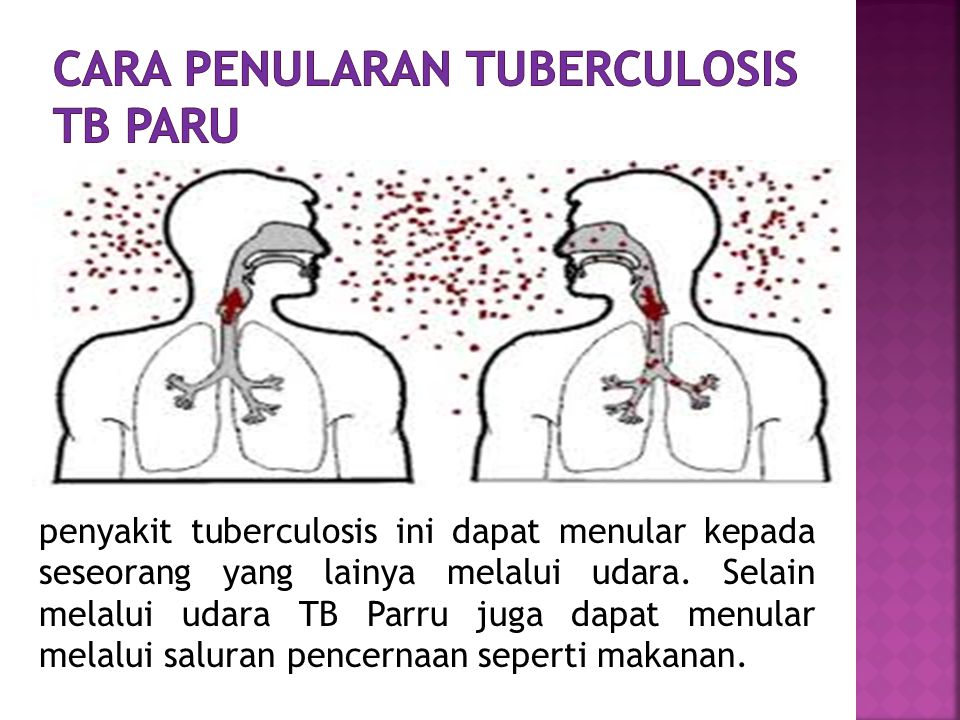 Cara penularan Tuberculosis TB Paru