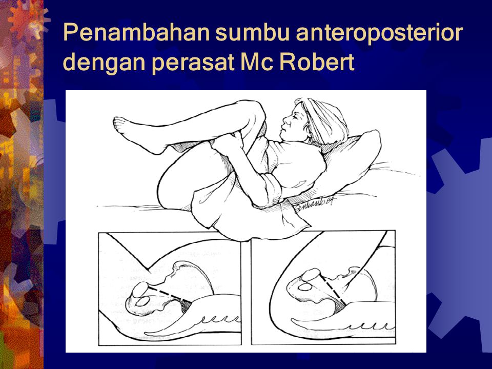 Penambahan sumbu anteroposterior dengan perasat Mc Robert