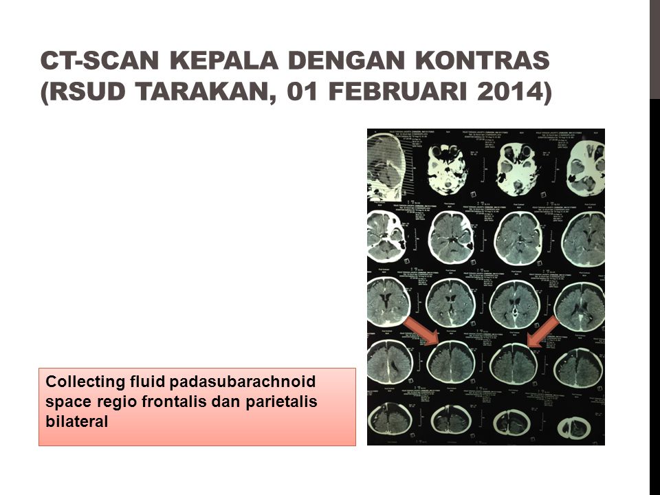 CT-SCAN KEPALA DENGAN KONTRAS (RSUD TARAKAN, 01 FEBRUARI 2014)