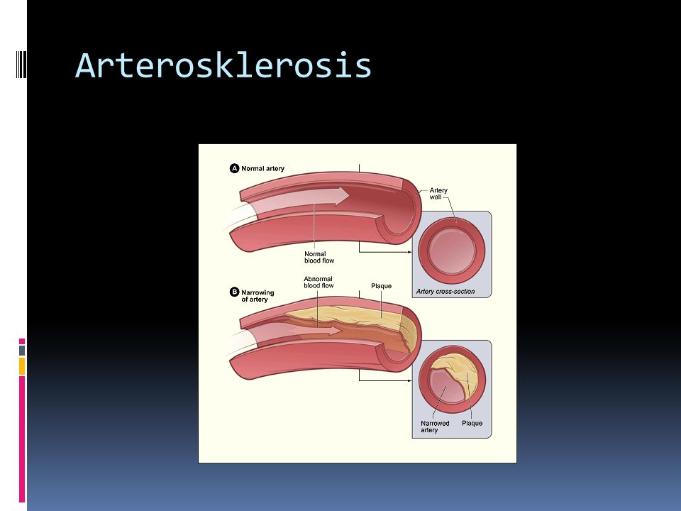 Arterosklerosis