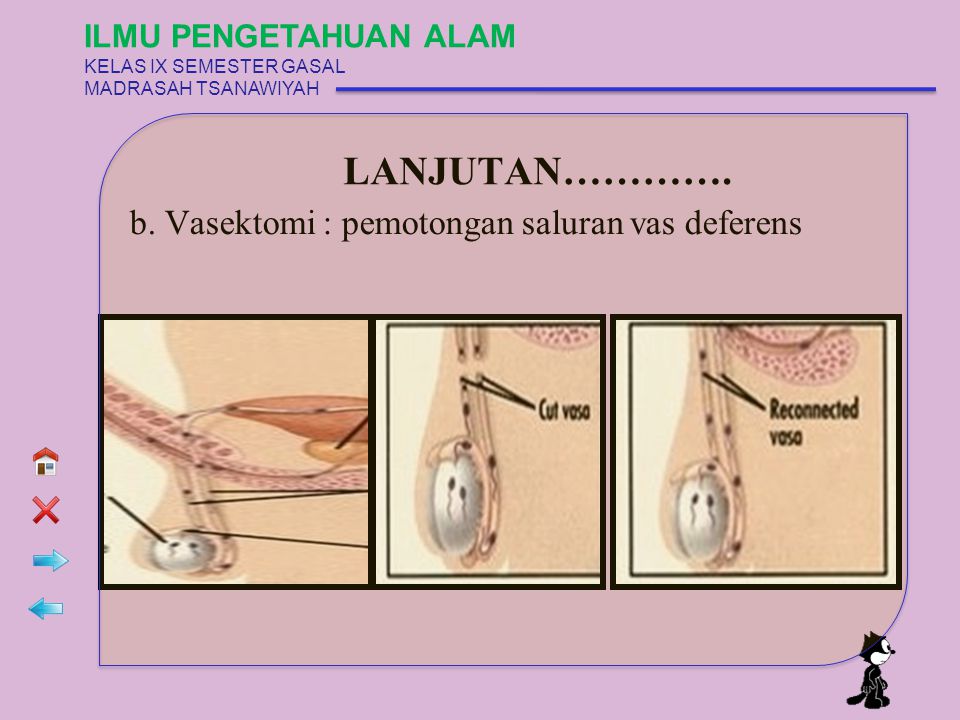 LANJUTAN…………. b. Vasektomi : pemotongan saluran vas deferens