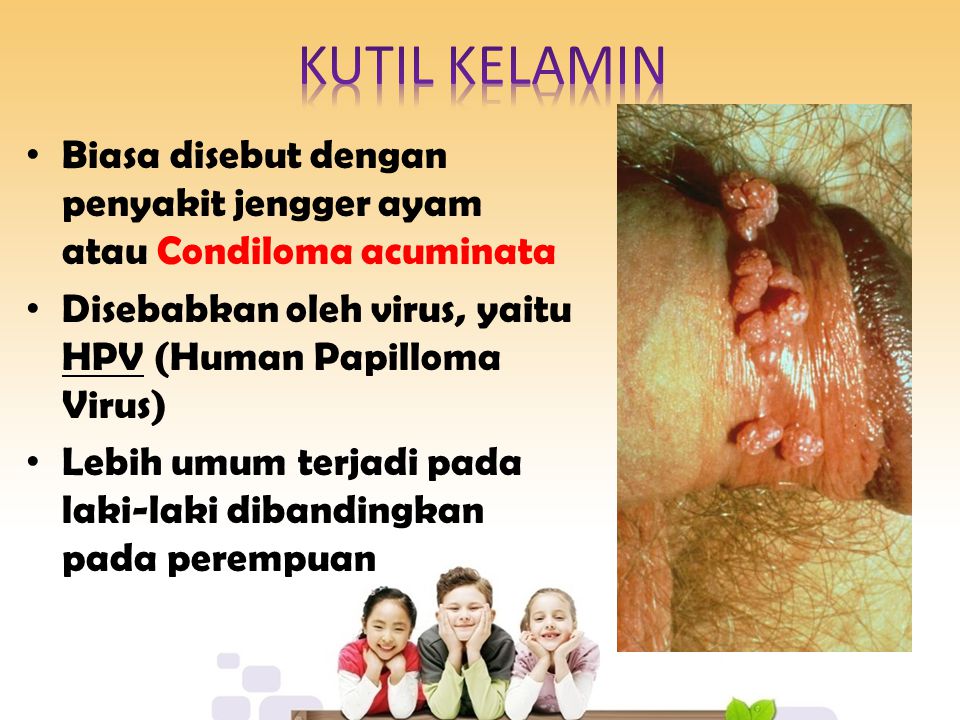 KUTIL KELAMIN Biasa disebut dengan penyakit jengger ayam atau Condiloma acuminata. Disebabkan oleh virus, yaitu HPV (Human Papilloma Virus)