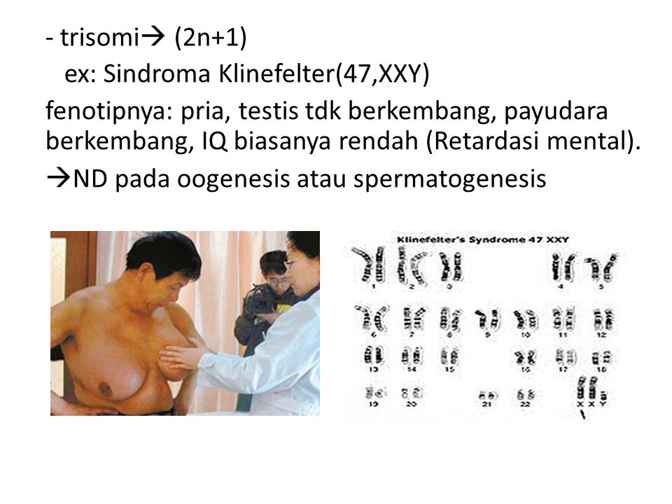 - trisomi (2n+1) ex: Sindroma Klinefelter(47,XXY)