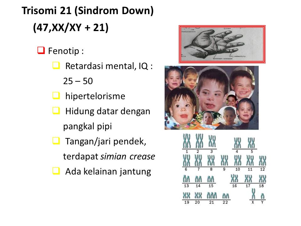 Trisomi 21 (Sindrom Down) (47,XX/XY + 21)