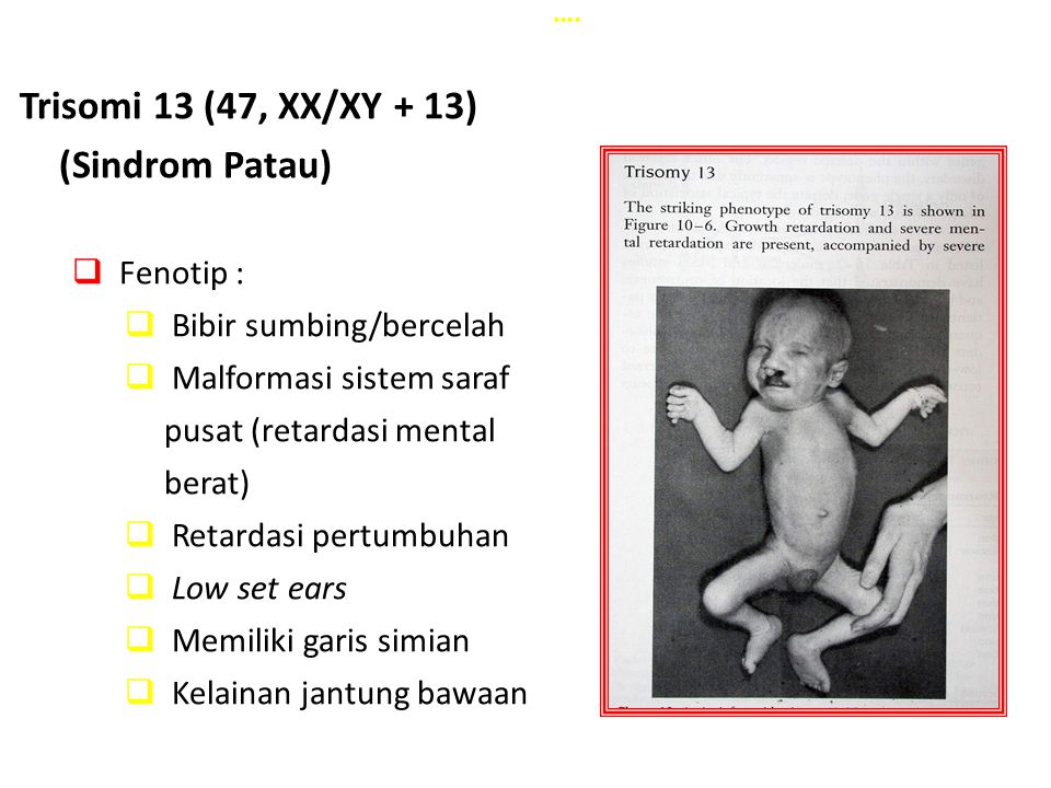 Trisomi 13 (47, XX/XY + 13) (Sindrom Patau)
