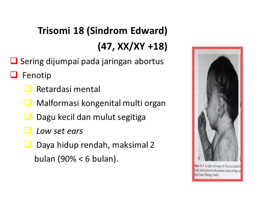 Trisomi 18 (Sindrom Edward) (47, XX/XY +18)