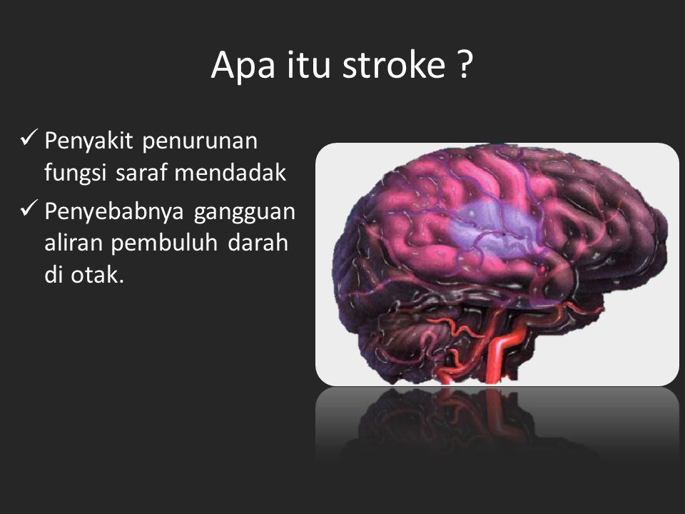 Apa itu stroke Penyakit penurunan fungsi saraf mendadak