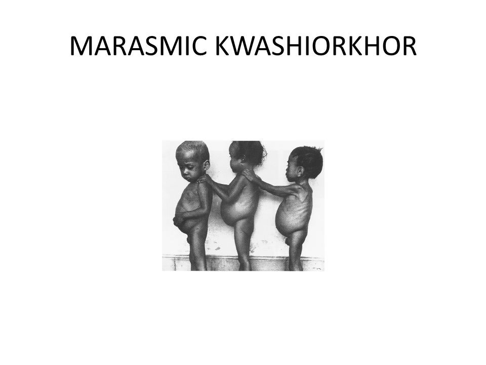 MARASMIC KWASHIORKHOR