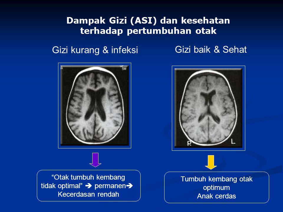 Dampak Gizi (ASI) dan kesehatan terhadap pertumbuhan otak