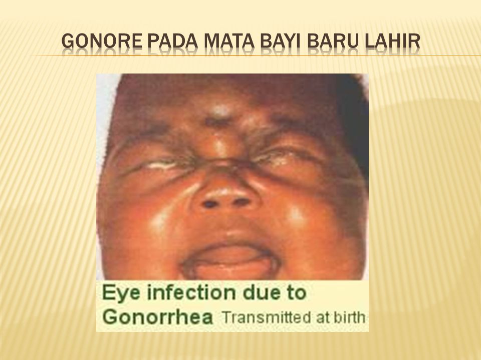 Gonore pada mata bayi baru lahir