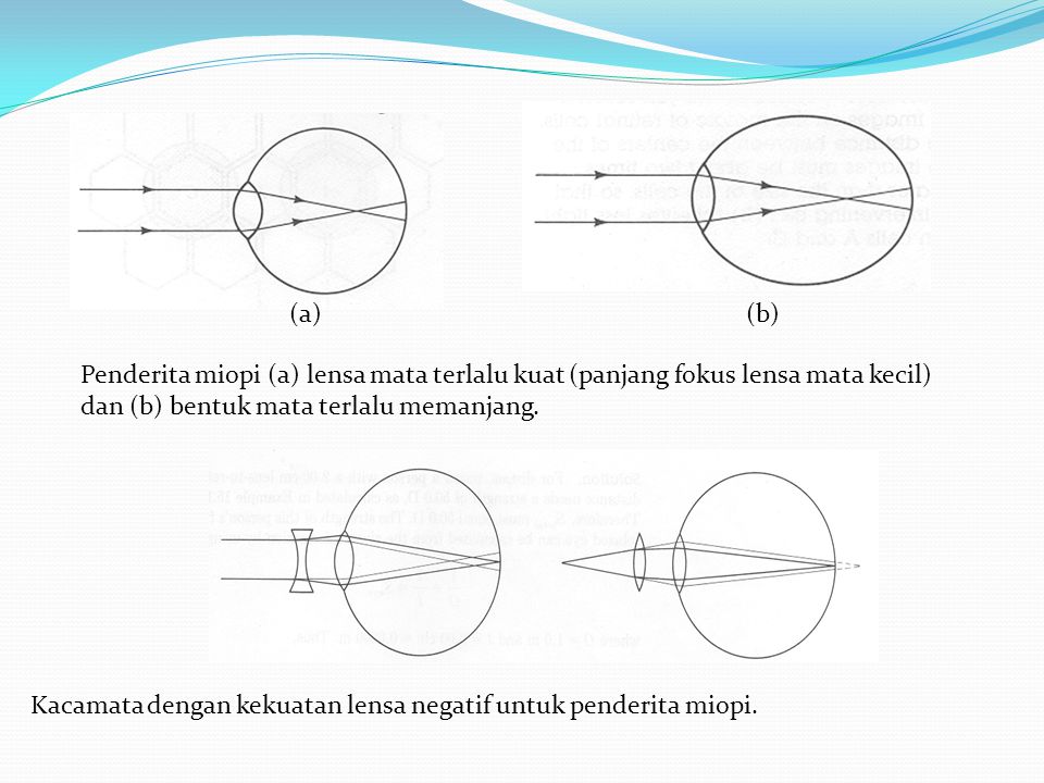 (a) (b) Penderita miopi (a) lensa mata terlalu kuat (panjang fokus lensa mata kecil) dan (b) bentuk mata terlalu memanjang.