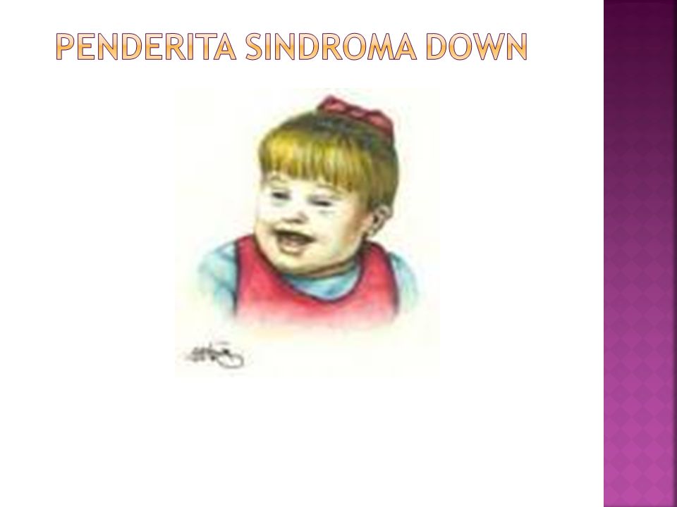 Penderita Sindroma down