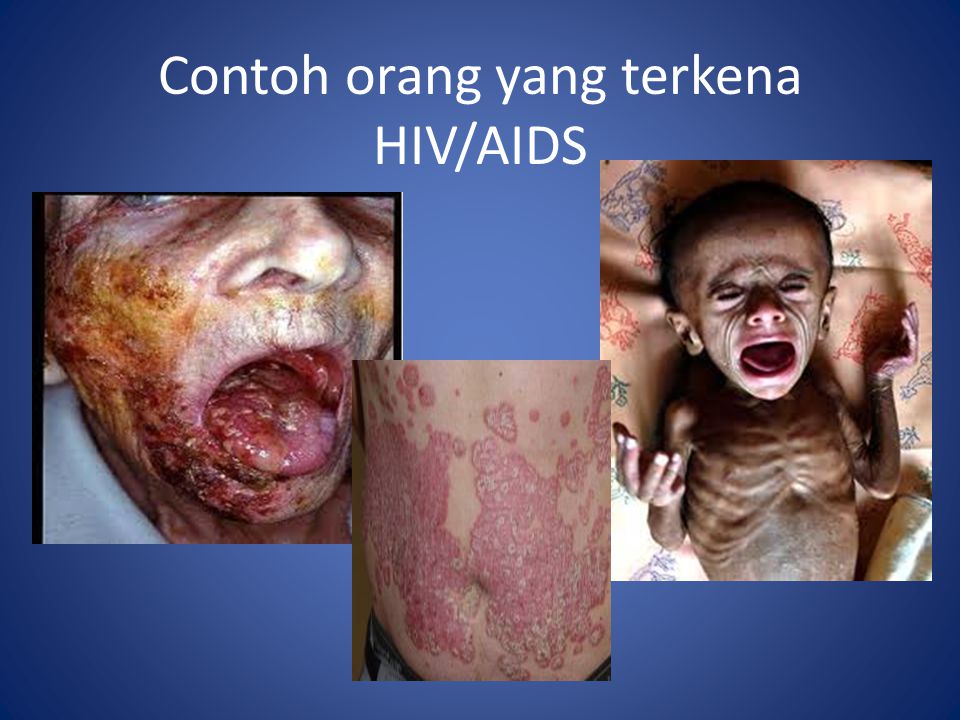 Contoh orang yang terkena HIV/AIDS