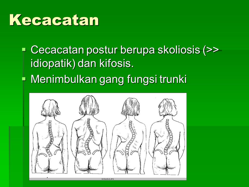 Kecacatan Cecacatan postur berupa skoliosis (>> idiopatik) dan kifosis.