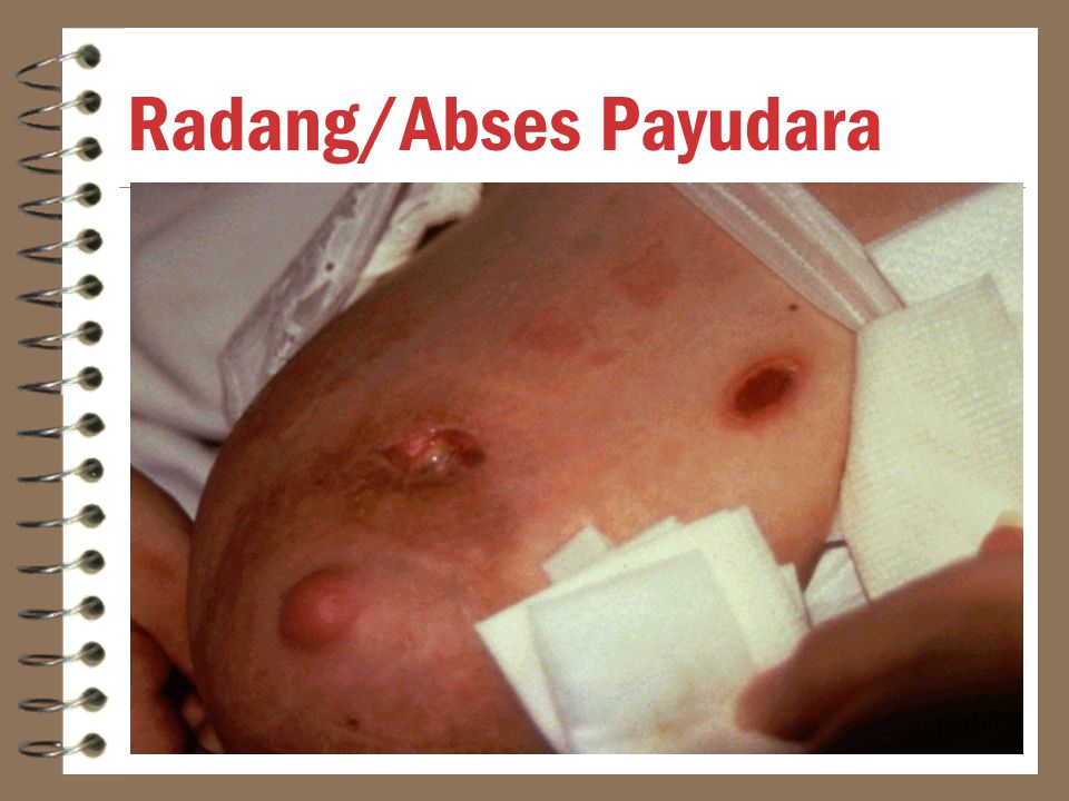 Radang/Abses Payudara