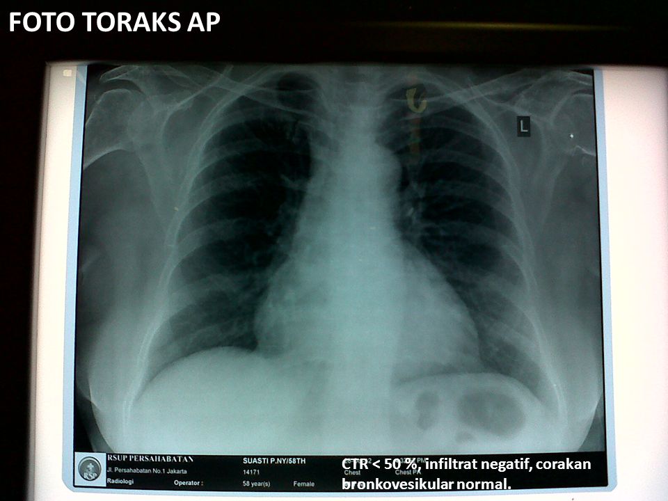 FOTO TORAKS AP CTR < 50 %, infiltrat negatif, corakan bronkovesikular normal.