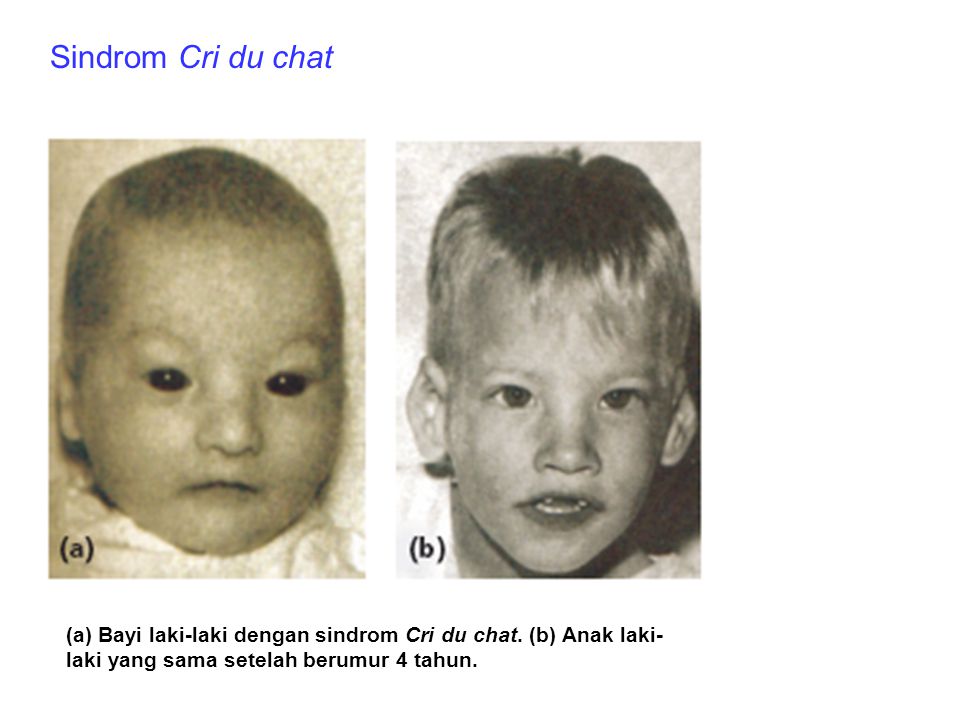 Sindrom Cri du chat (a) Bayi laki-laki dengan sindrom Cri du chat.