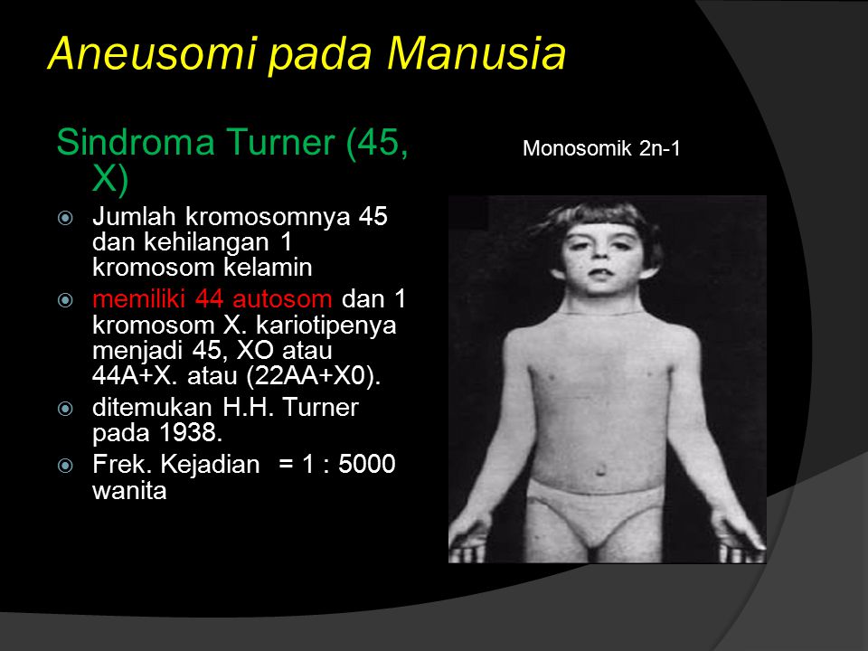 Aneusomi pada Manusia Sindroma Turner (45, X)