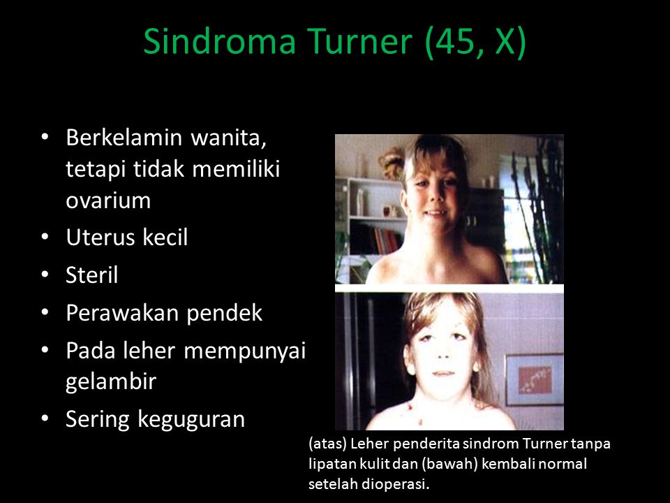 Sindroma Turner (45, X) Berkelamin wanita, tetapi tidak memiliki ovarium. Uterus kecil. Steril. Perawakan pendek.