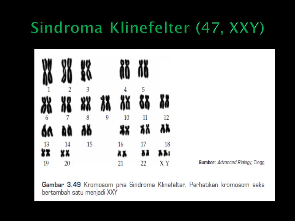 Sindroma Klinefelter (47, XXY)