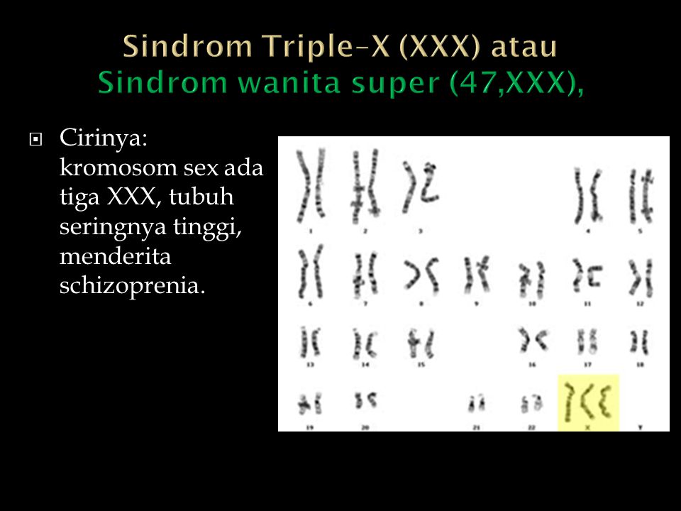 Sindrom Triple–X (XXX) atau Sindrom wanita super (47,XXX),