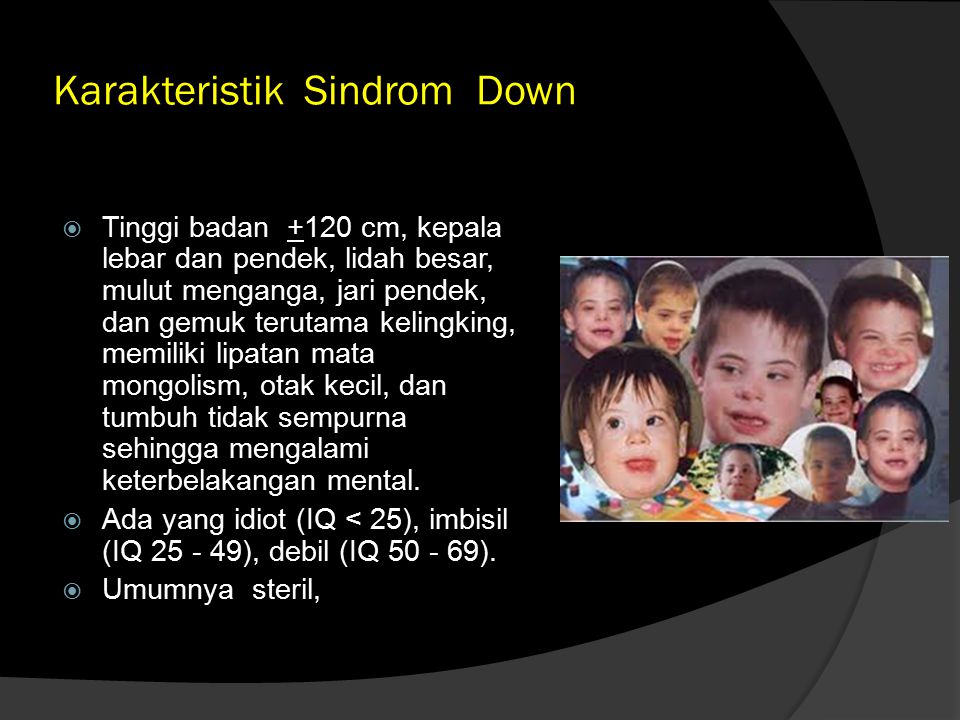 Karakteristik Sindrom Down