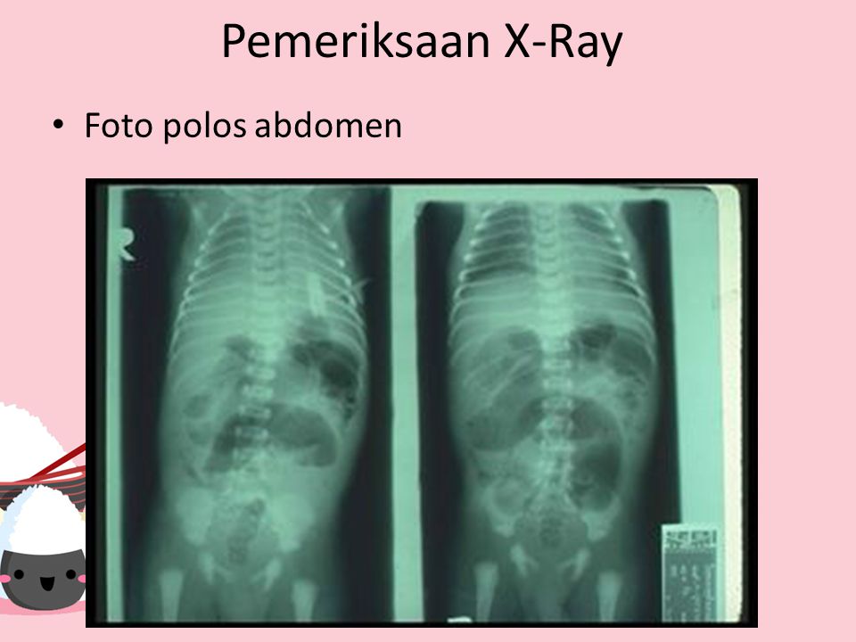 Pemeriksaan X-Ray Foto polos abdomen