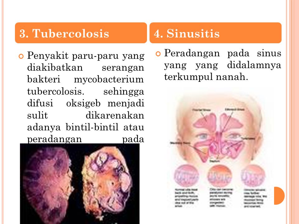 3. Tubercolosis 4. Sinusitis