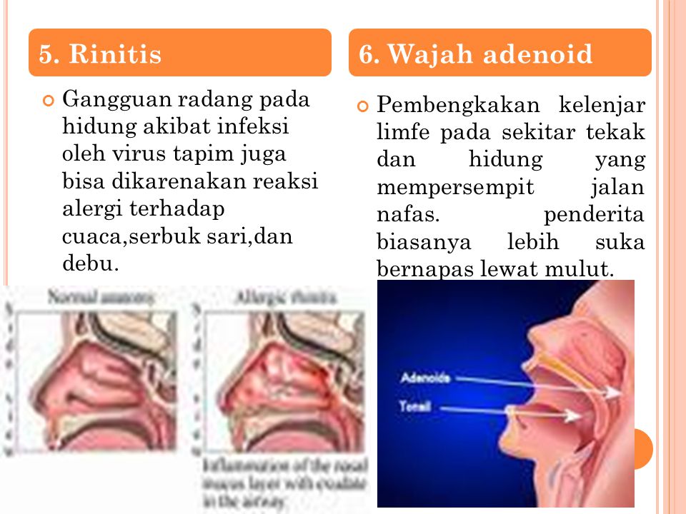 5. Rinitis 6. Wajah adenoid.