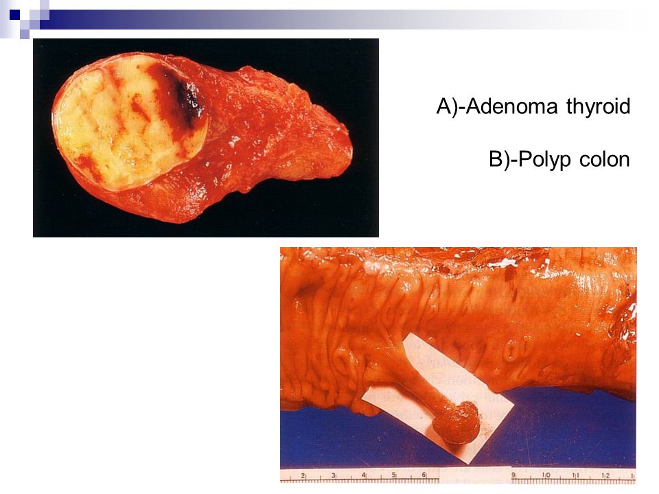 A)-Adenoma thyroid B)-Polyp colon