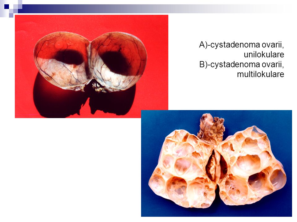 A)-cystadenoma ovarii, unilokulare B)-cystadenoma ovarii, multilokulare