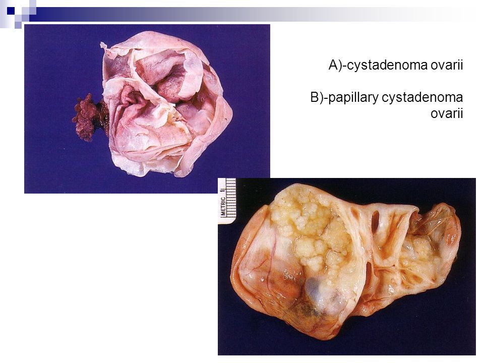 A)-cystadenoma ovarii B)-papillary cystadenoma ovarii
