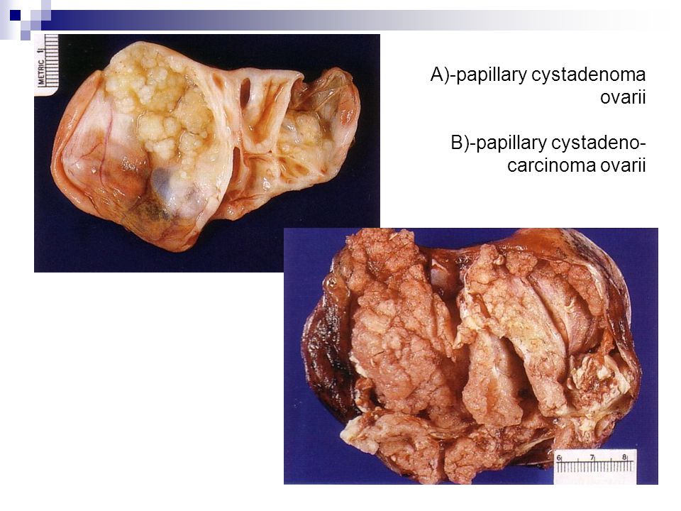 A)-papillary cystadenoma ovarii B)-papillary cystadeno- carcinoma ovarii
