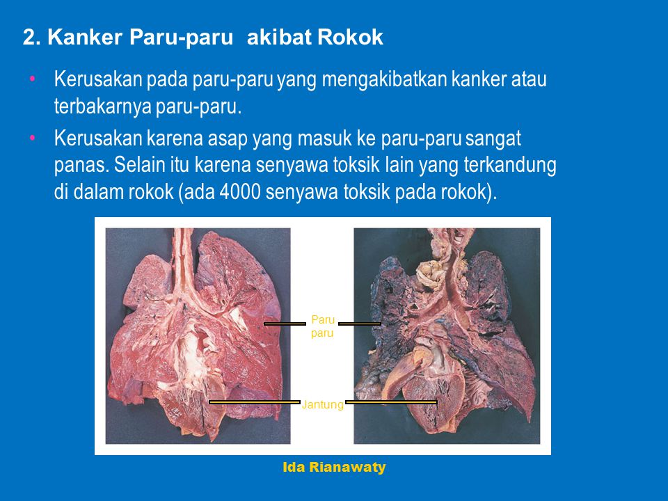 2. Kanker Paru-paru akibat Rokok
