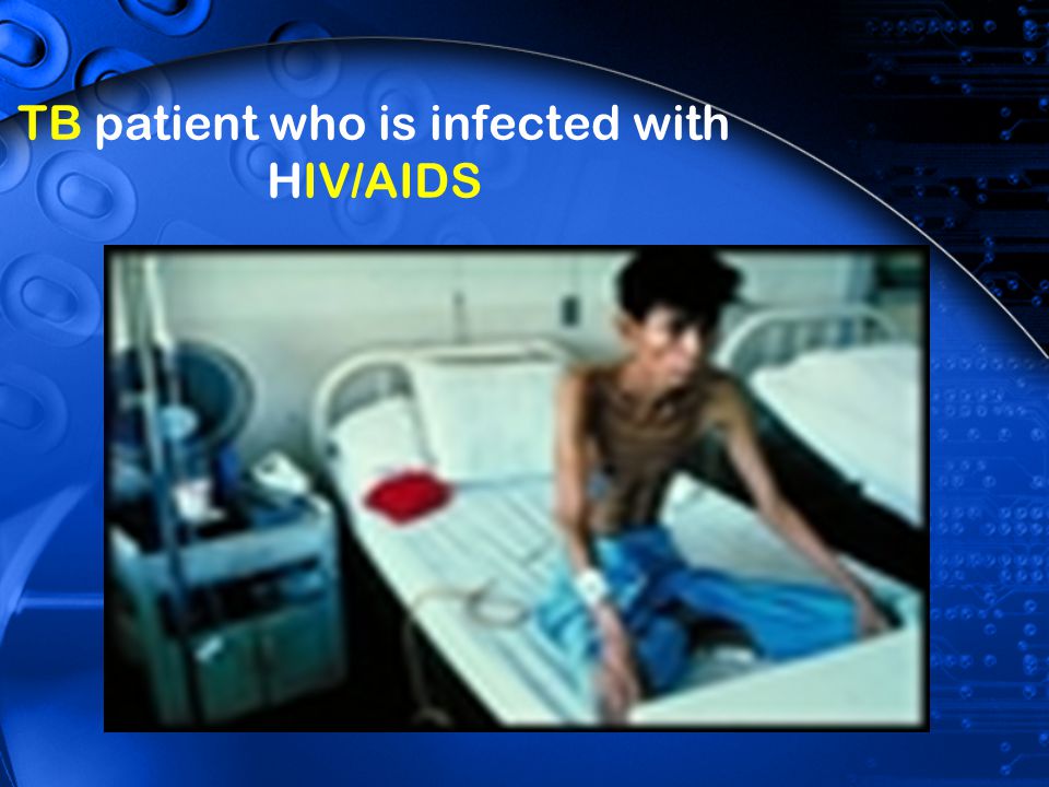 TB patient who is infected with HIV/AIDS