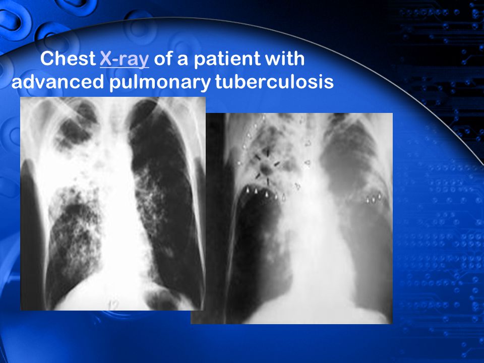 Chest X-ray of a patient with advanced pulmonary tuberculosis