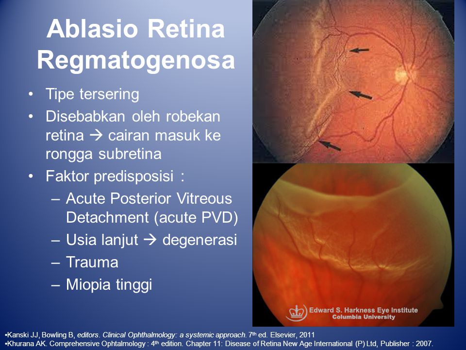Dr. Diag - Tractios ablatio retinae
