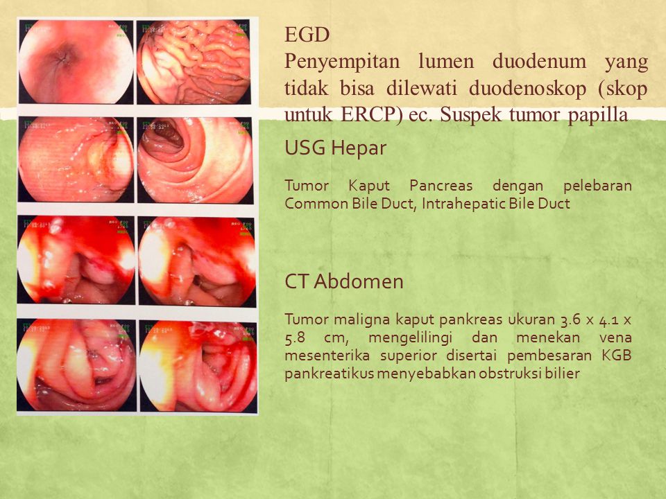 EGD Penyempitan lumen duodenum yang tidak bisa dilewati duodenoskop (skop untuk ERCP) ec. Suspek tumor papilla.