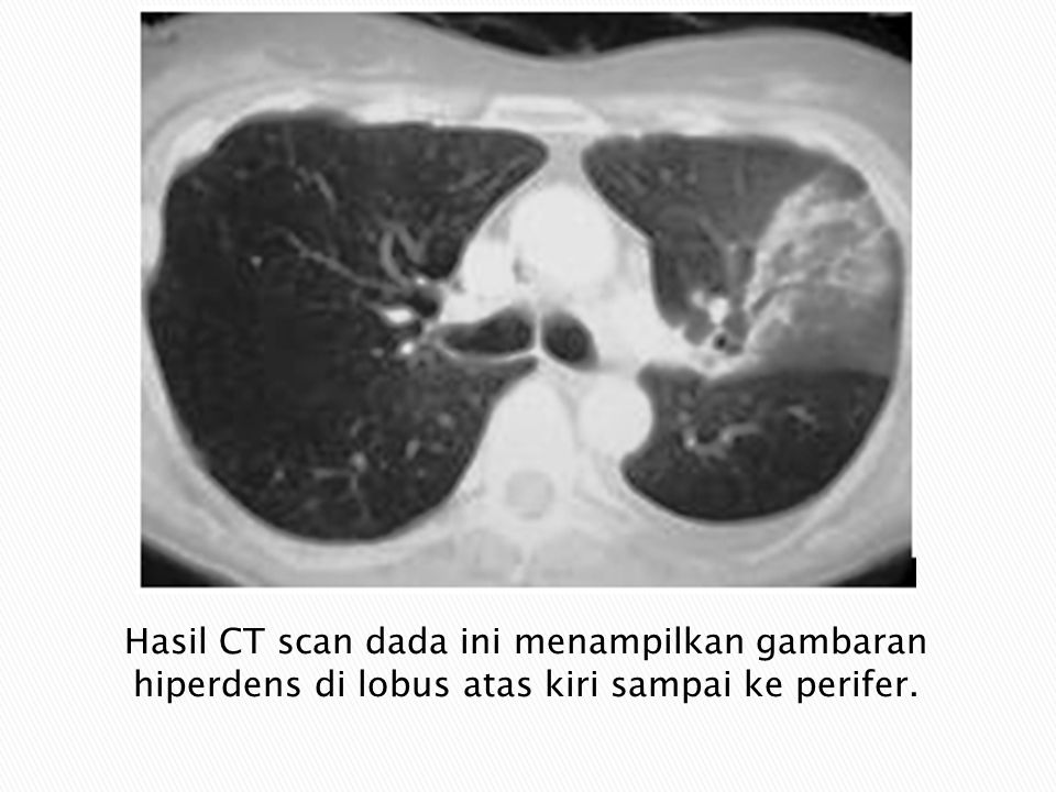 Hasil CT scan dada ini menampilkan gambaran hiperdens di lobus atas kiri sampai ke perifer.