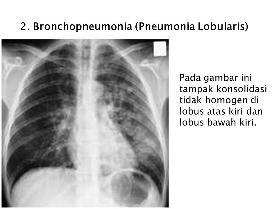 2. Bronchopneumonia (Pneumonia Lobularis)