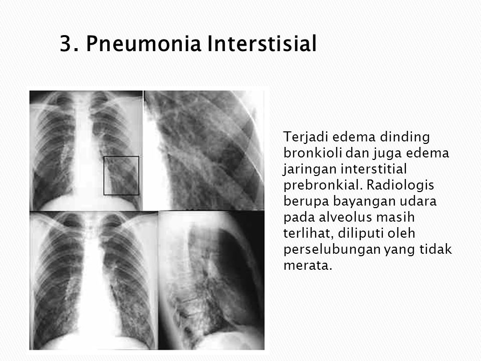 3. Pneumonia Interstisial