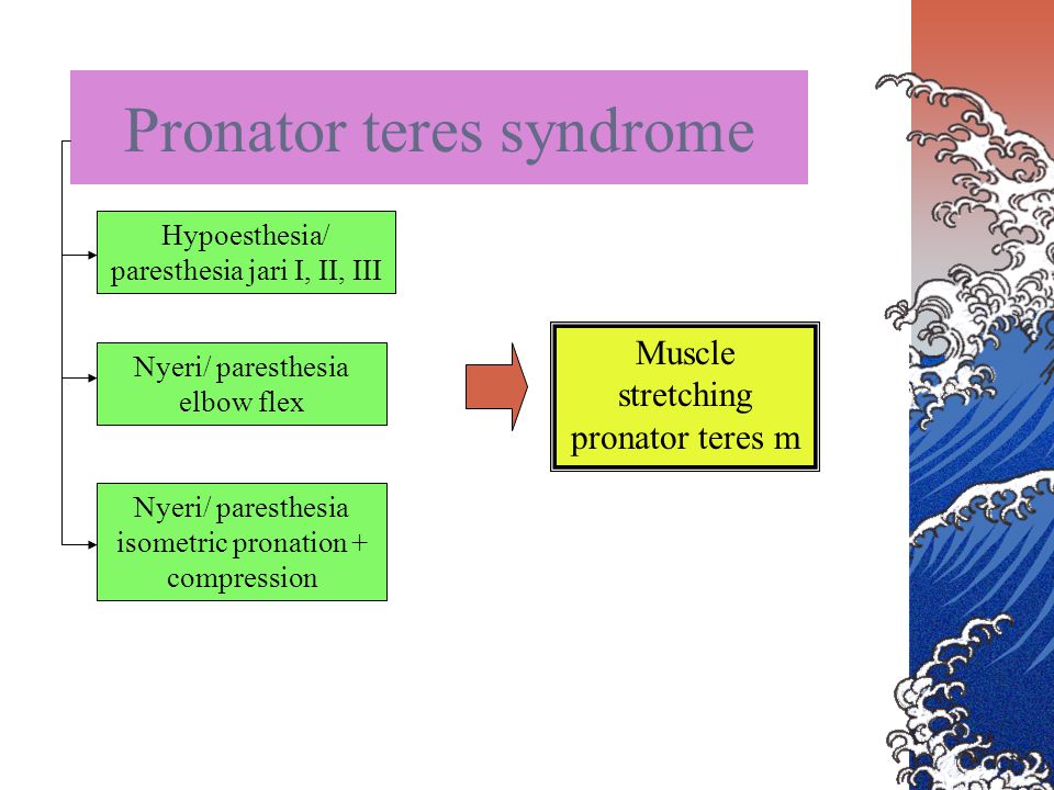 Pronator teres syndrome