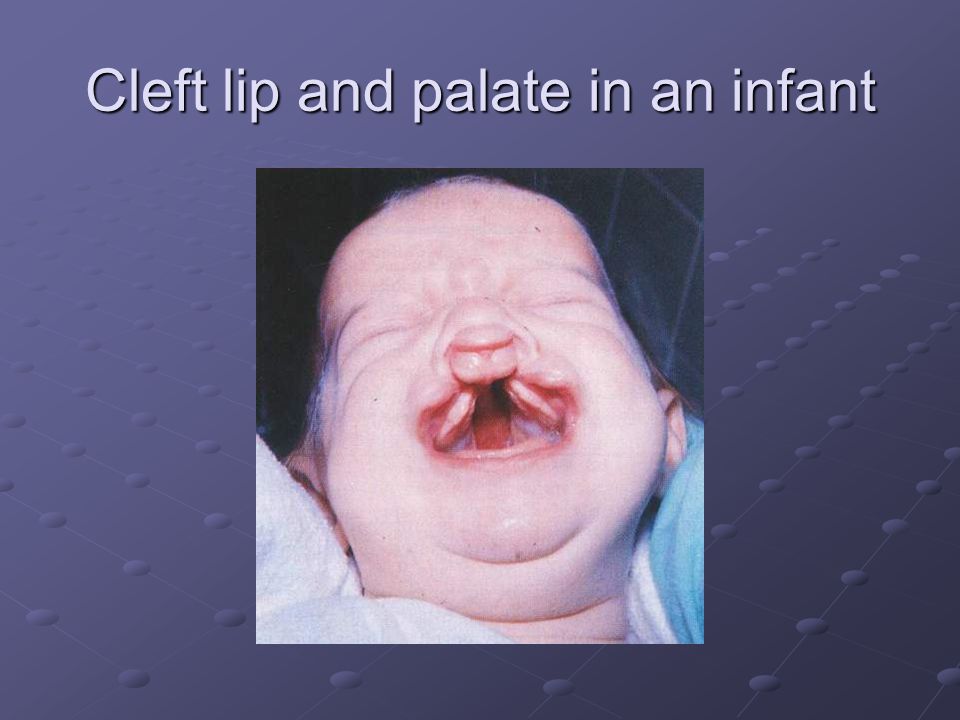 Cleft lip and palate in an infant