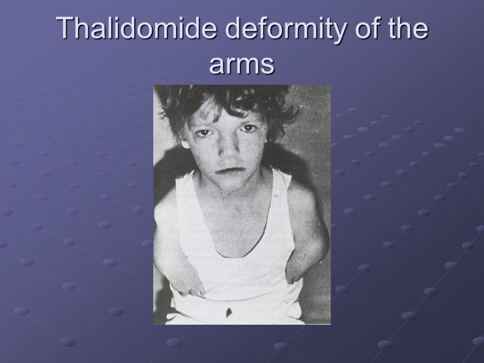 Thalidomide deformity of the arms