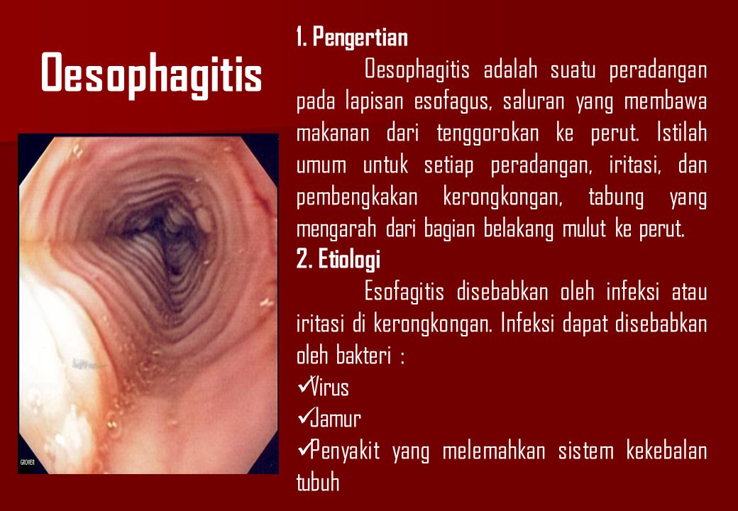 Oesophagitis 1. Pengertian