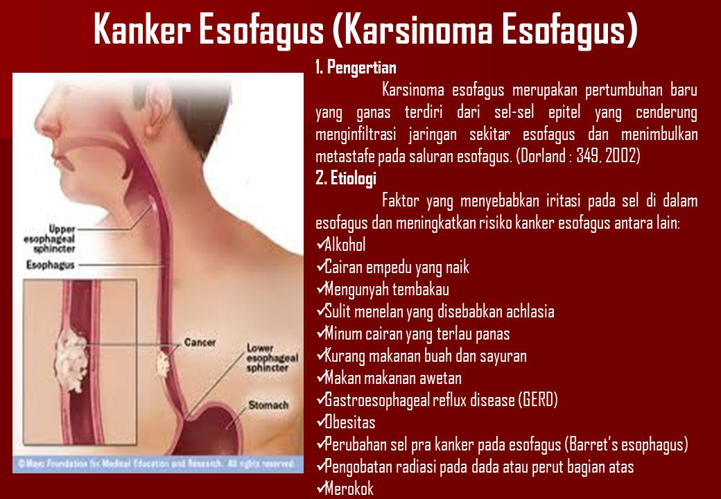 Kanker Esofagus (Karsinoma Esofagus)