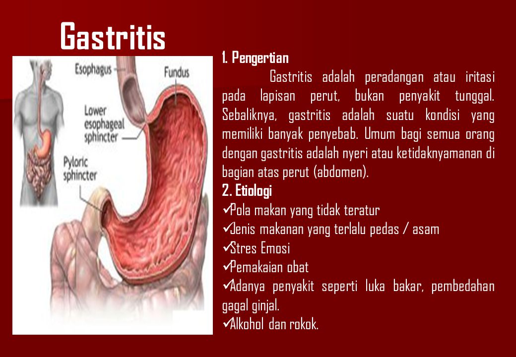 Gastritis 1. Pengertian.