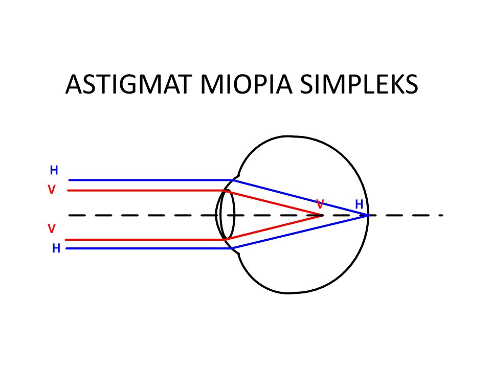 astigmatism myopia simplex adalah rossz látással járó osteopathia