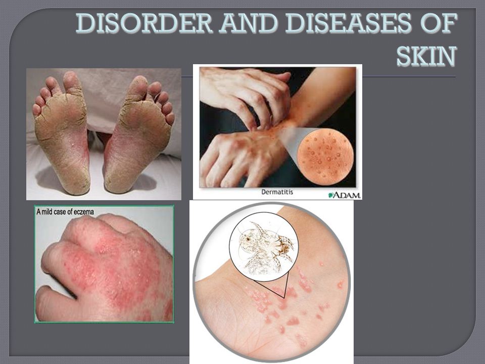 DISORDER AND DISEASES OF SKIN